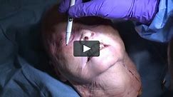 Partial Face Transplant (Upper and Lower Jaw Recovery)