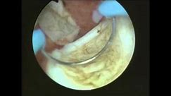 Hysteroskopische Myom- & Polypentfernung - Hysteroscopic Myomectomy & Polypectomy