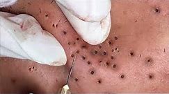Top of Blackhead Extraction Video 2020 - Best Blackhead Removal Videos 2020