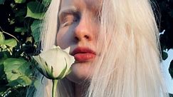 Bullied for being ALBINO but I've embraced my pale skin and white hair - video Dailymotion