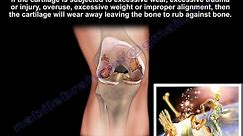 Knee Pain , Knee arthritis treatment - Everything You Need To Know - Dr. Nabil Ebraheim, M.D.
