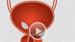 Chyluria for Patient Education - Health Video | Medindia