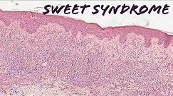 Sweet syndrome explained in 5 minutes (pathology histology dermatology dermpath USMLE)