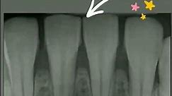 Periapical Radiograph | Dental X-ray