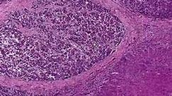 Histopathology Liver--Hepatocellular carcinoma in cirrhosis