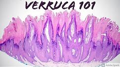 Wart under microscope.Verruca 101: More than you ever wanted to know! Pathology Dermatology Dermpath