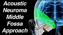 Middle Fossa Approach to Acoustic Neuroma Surgical Removal