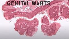 Genital warts under the microscope (Condyloma HPV pathology dermpath dermatology dermatopathology)
