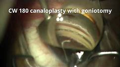Sight Sciences OMNI canaloplasty by Dr. David Chia