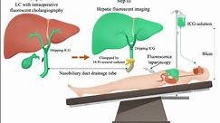 Preliminary exploration of hepatic parenchymal near-infrared fluorescence imaging technique via retrograde biliary approach: a feasibility study (with video) - Scientific Reports