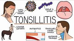 Understanding Tonsillitis
