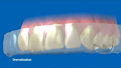 NEW Crest Whitestrips Advanced Seal - How it works