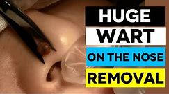 HUGE Wart On The Nose (Facial Wart Removal)