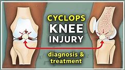 Cyclops injury of the knee -Diagnosis and treatment