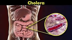 Cholera: Causes, Symptoms and Treatments