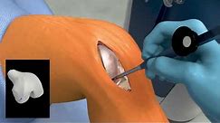 Mako Robotic-Arm Assisted Partial Knee Replacement
