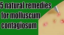 5 natural remedies for molluscum contagiosum | molluscum contagiosum Treatment
