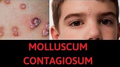 What is Molluscum Contagiosum? Symptoms, Treatment