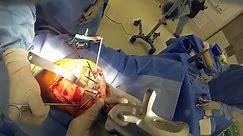 Total Knee Replacement Surgery - video Dailymotion