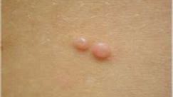Molluscum Contagiosum  - do you squeeze and pop or not?