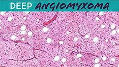 Deep Angiomyxoma (large deep mass/tumor around vulva vagina and/or uterus) pathology gynecology
