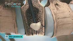 SetBone Medical's novel bone cement