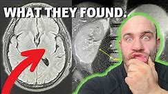 I DID A WHOLE BODY MRI SCAN
