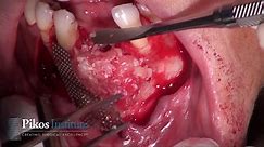 Video 8: Titanium Mesh / rhBMP-2 Bone Graft for Mandibular Anterior Horizontal Deficiency