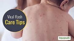 Tips To Identify and Diagnose A Viral Rash in Infants