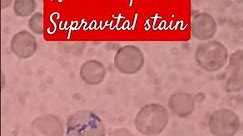 Reticulocytes in Supravital staining |New Methylene Blue