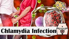 Chlamydia Infection - Causes, Risk Factors, Transmission, Signs & Symptoms, Diagnosis & Treatment