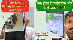Chyluria with Milky and Bloody Urine got cured in 4 days - Dr Ravi Singh