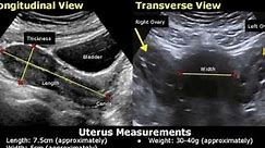 How to measure Uterus on ultrasound|Length,Width, Diameter