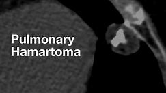 Classic Case: Pulmonary Hamartoma