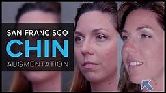 Non Surgical Chin Augmentation at Mabrie Facial Institute