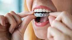 What Are the Best Teeth Aligners in the UK? Treatment, Costs, Reviews