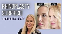 Revision Rhinoplasty Surprise: "I HAVE A REAL NOSE!" | Dr. Ben Talei | Beverly Hills, CA