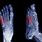 5th Metatarsal Jones Fracture Foot