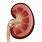 A Kidney Stone