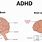 ADHD Brain Structure