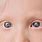 Albino Eyes in Humans