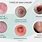 All Types of Skin Cancer