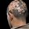 Alopecia Areata Images