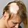 Alopecia Symptoms