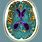 Alzheimer's MRI Brain Scan