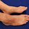 Atopic Dermatitis Feet