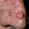 Basal Carcinoma On Nose