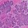 Basal Cell Carcinoma Under Microscope