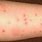 Bed Bugs On Skin