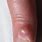Benign Tumor On Finger